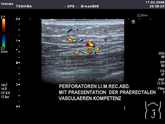  Perforatoren im Ultraschall darstellbar"